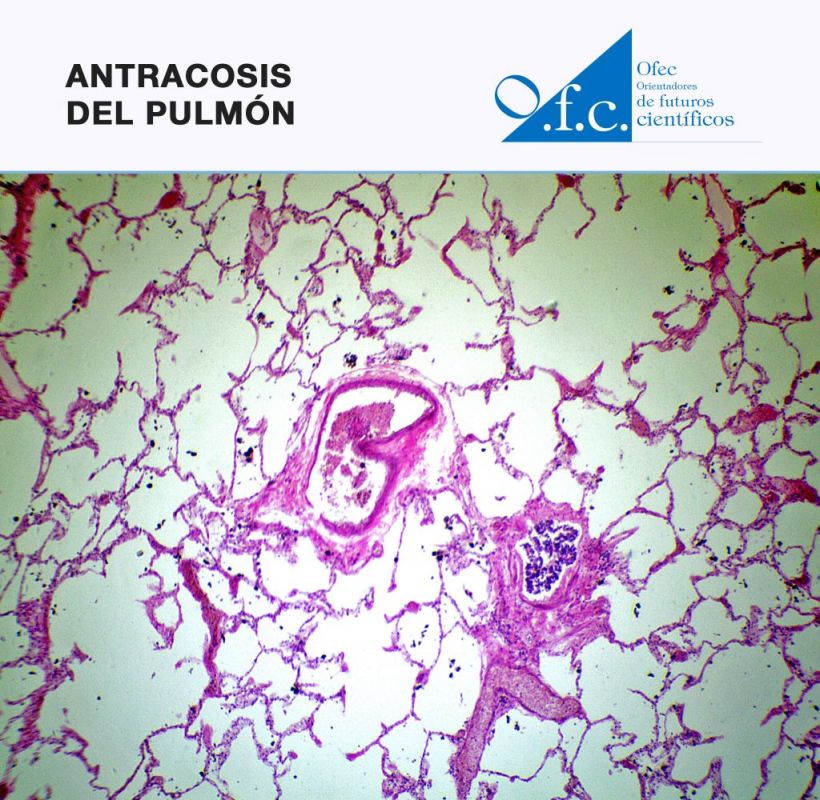 Antracosis del pulmón