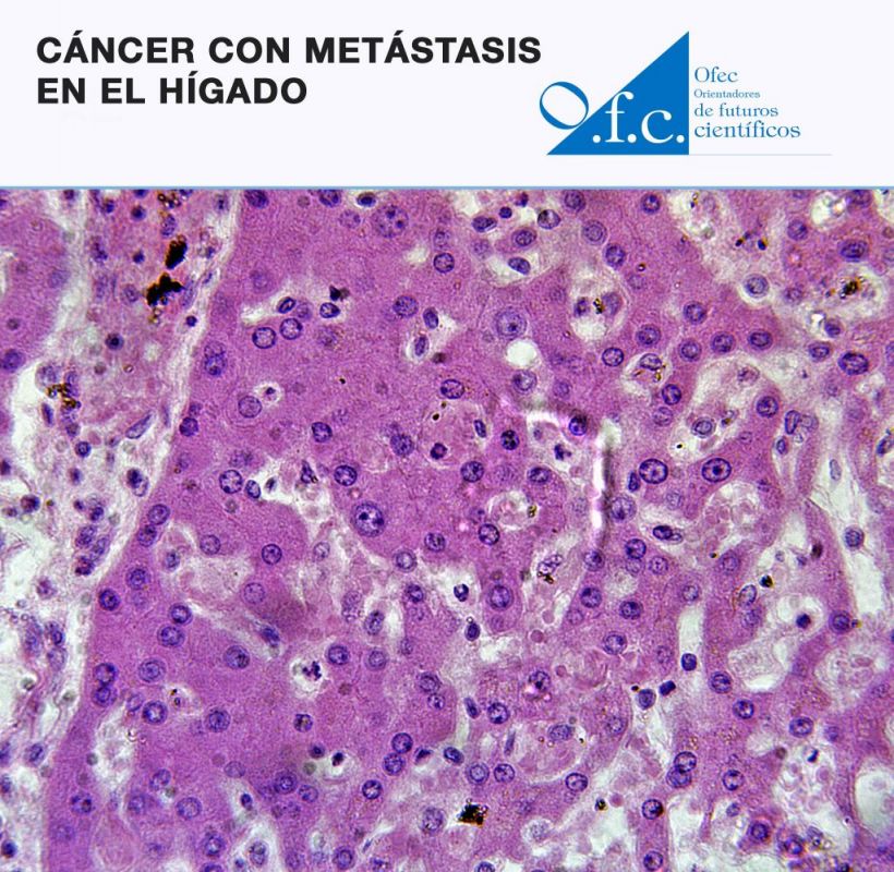 Cáncer con metástasis en el hígado