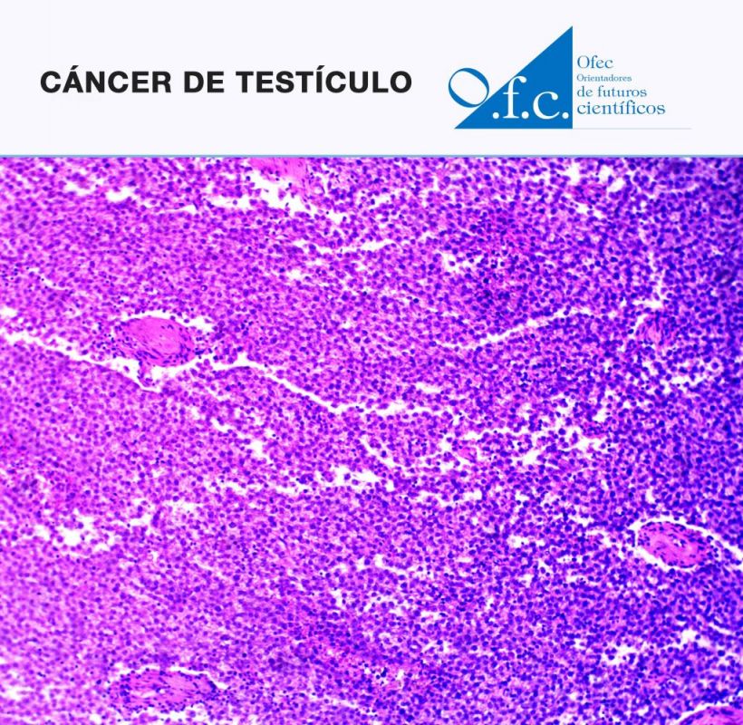 Cáncer de testículo