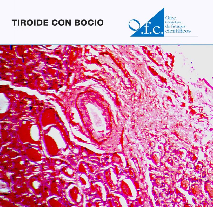 Tiroide con bocio