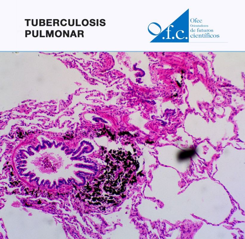 Tuberculosis pulmonar